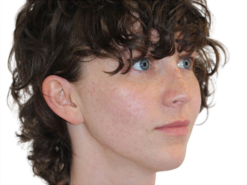 Filler Before and After | PERK Plastic Surgery