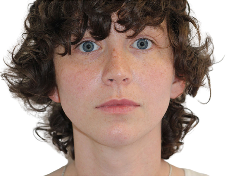 Filler Before and After | PERK Plastic Surgery