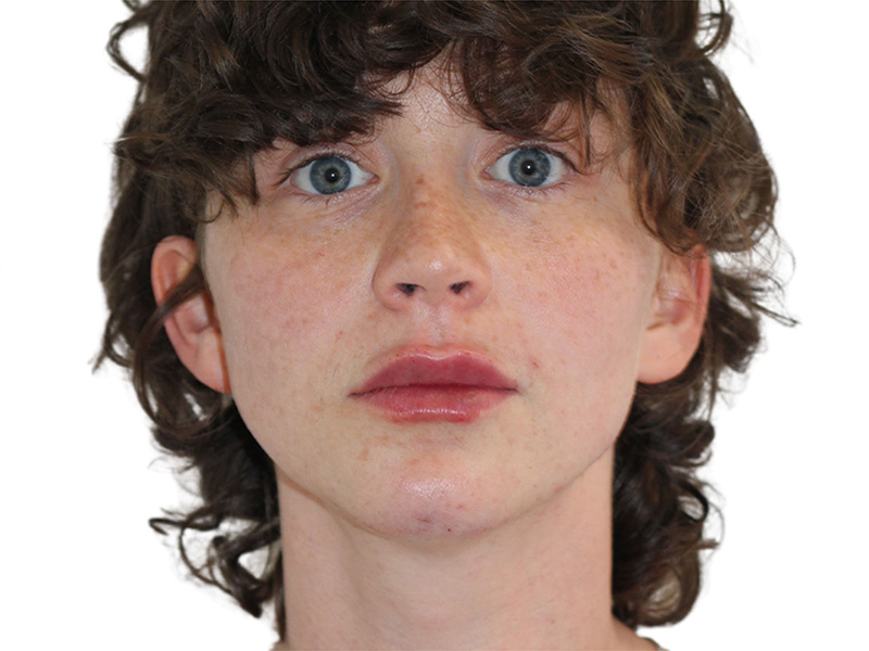 Filler Before and After | PERK Plastic Surgery