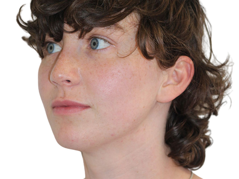 Filler Before and After | PERK Plastic Surgery