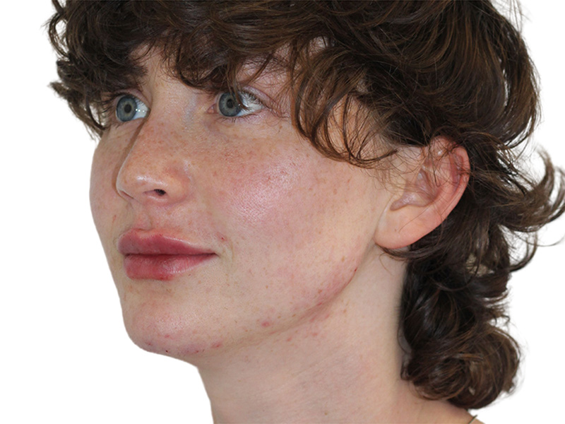 Filler Before and After | PERK Plastic Surgery