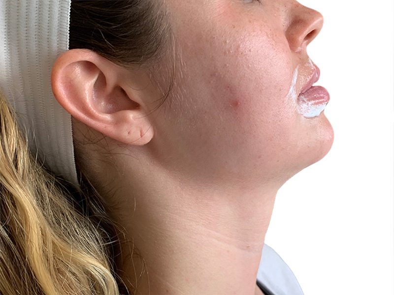 Filler Before and After | PERK Plastic Surgery