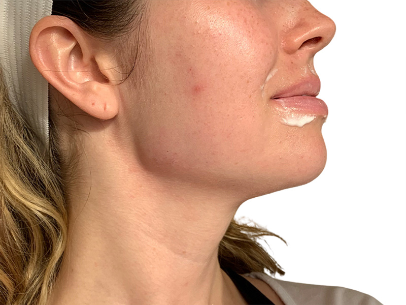 Filler Before and After | PERK Plastic Surgery