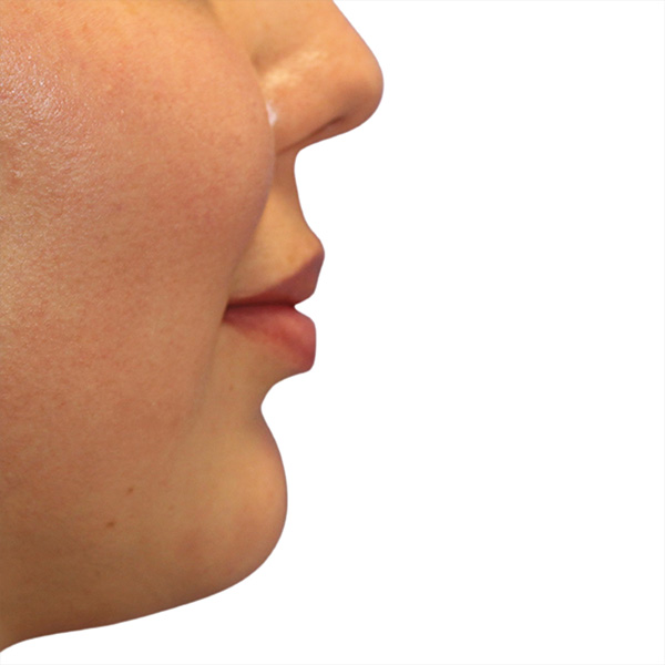 Filler Before and After | PERK Plastic Surgery