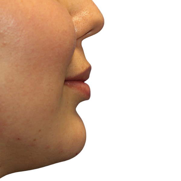 Filler Before and After | PERK Plastic Surgery