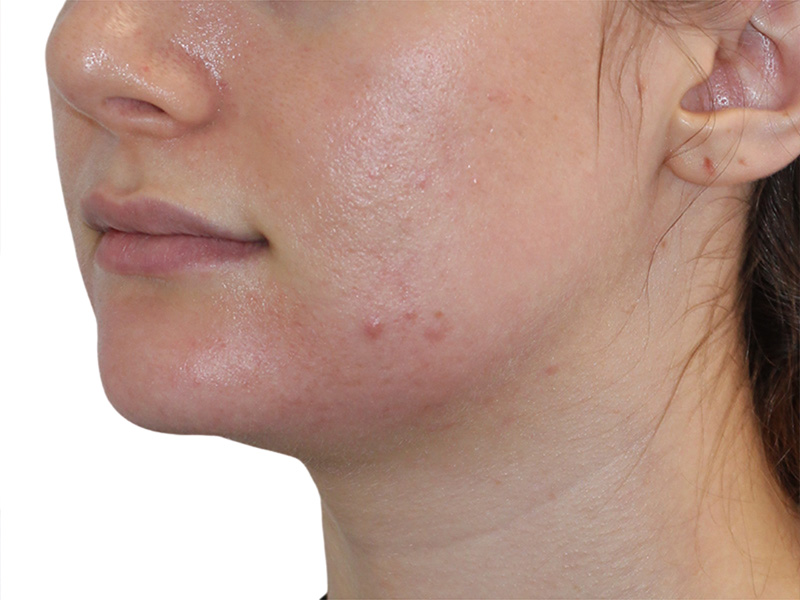 Filler Before and After | PERK Plastic Surgery