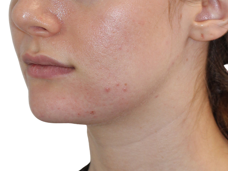 Filler Before and After | PERK Plastic Surgery