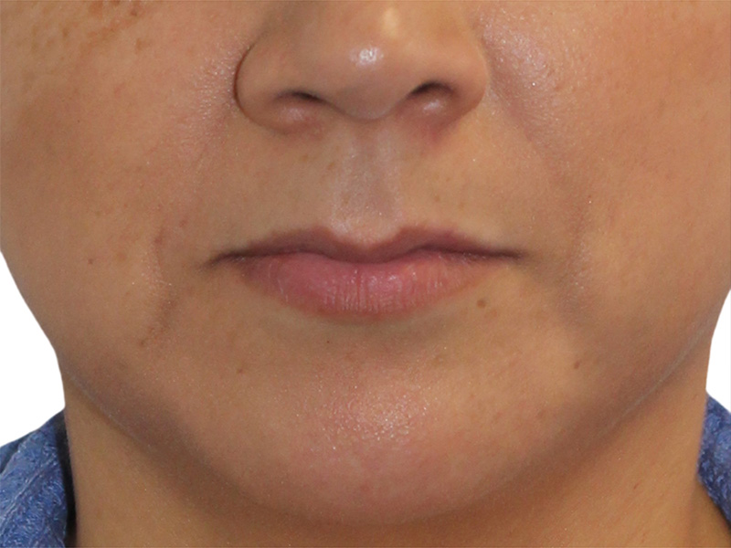 Filler Before and After | PERK Plastic Surgery