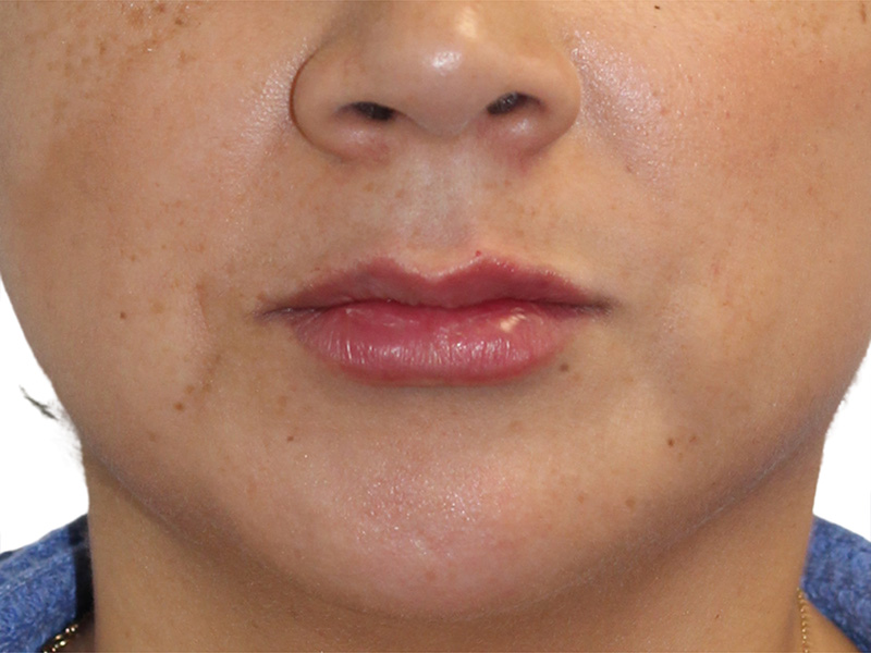 Filler Before and After | PERK Plastic Surgery