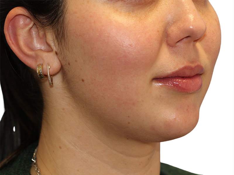 Liquid Rhinoplasty Beverly Hills