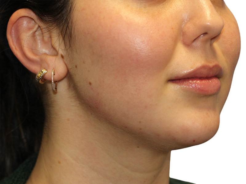 Liquid Rhinoplasty Beverly Hills