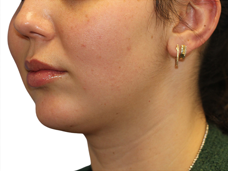 Filler Before and After | PERK Plastic Surgery