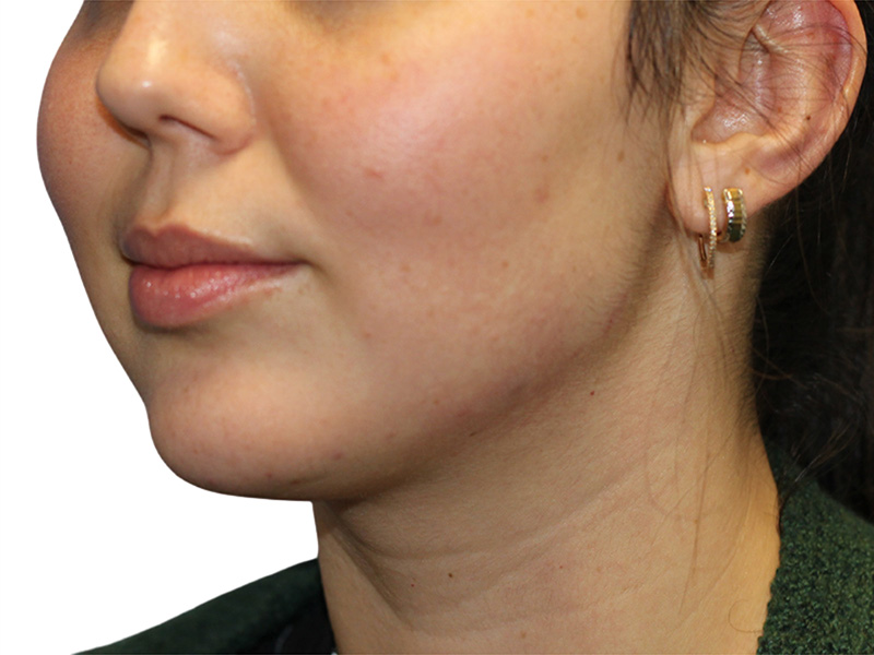 Filler Before and After | PERK Plastic Surgery