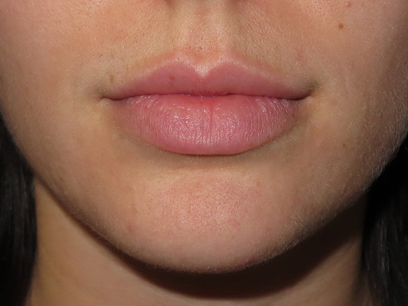 Filler Before and After | PERK Plastic Surgery