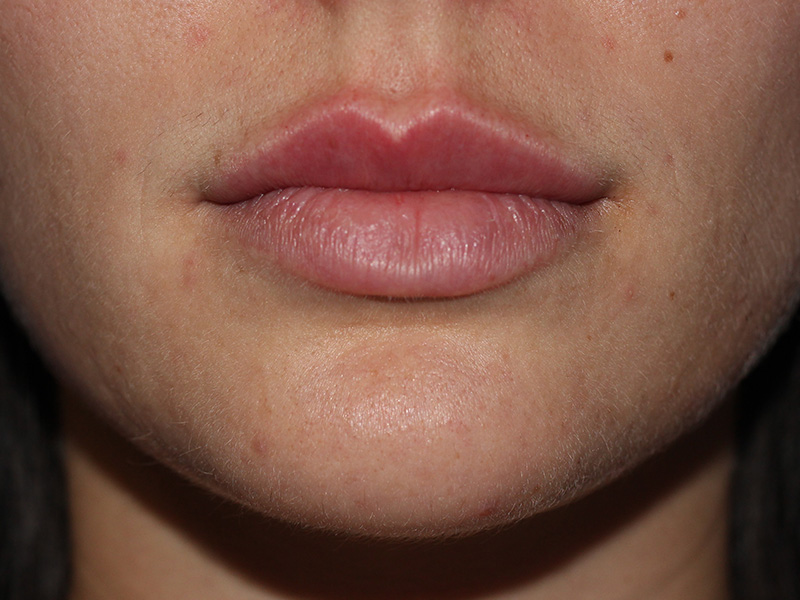 Filler Before and After | PERK Plastic Surgery