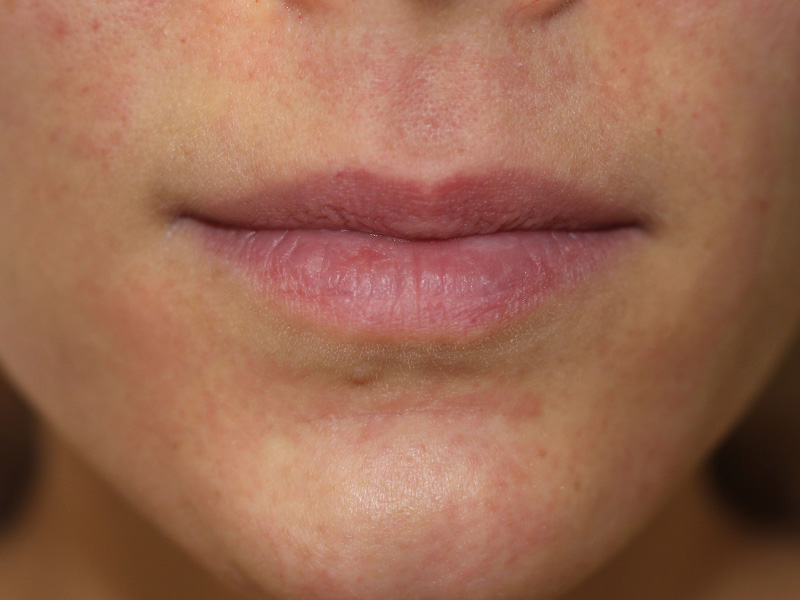 Filler Before and After | PERK Plastic Surgery