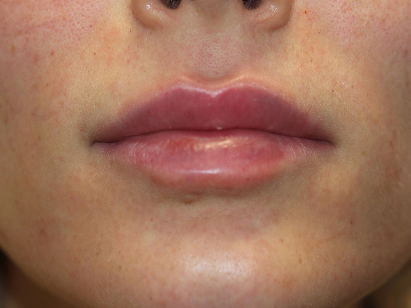 Filler Before and After | PERK Plastic Surgery