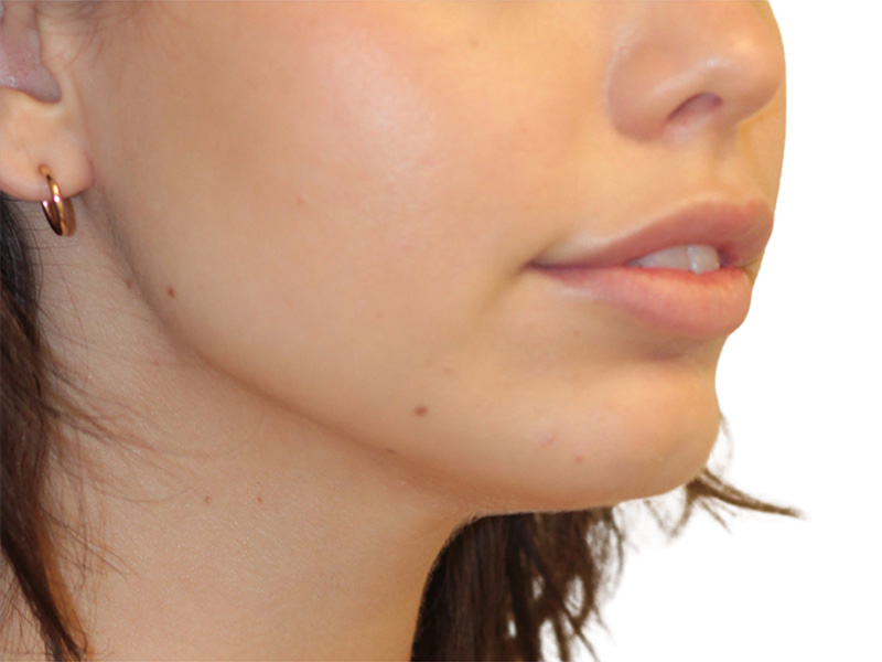 Filler Before and After | PERK Plastic Surgery