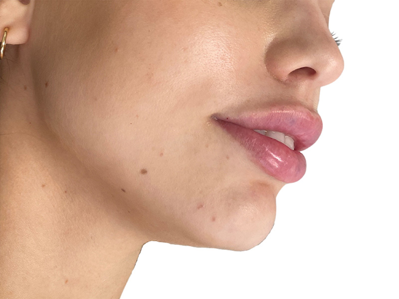 Filler Before and After | PERK Plastic Surgery