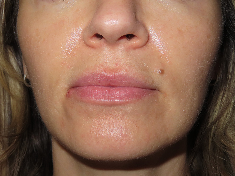 Filler Before and After | PERK Plastic Surgery