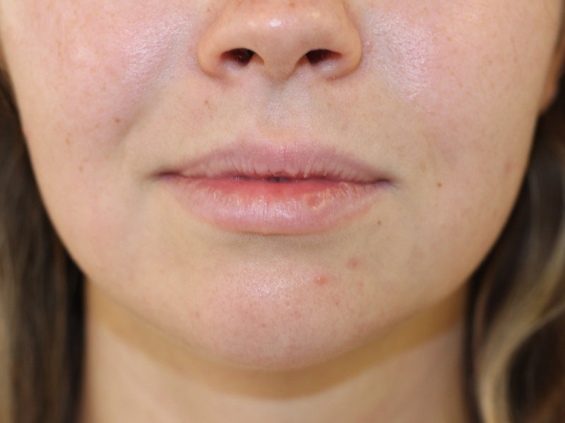 Filler Before and After | PERK Plastic Surgery