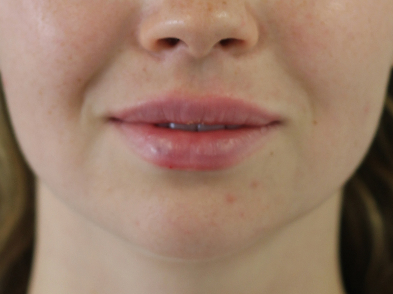 Filler Before and After | PERK Plastic Surgery
