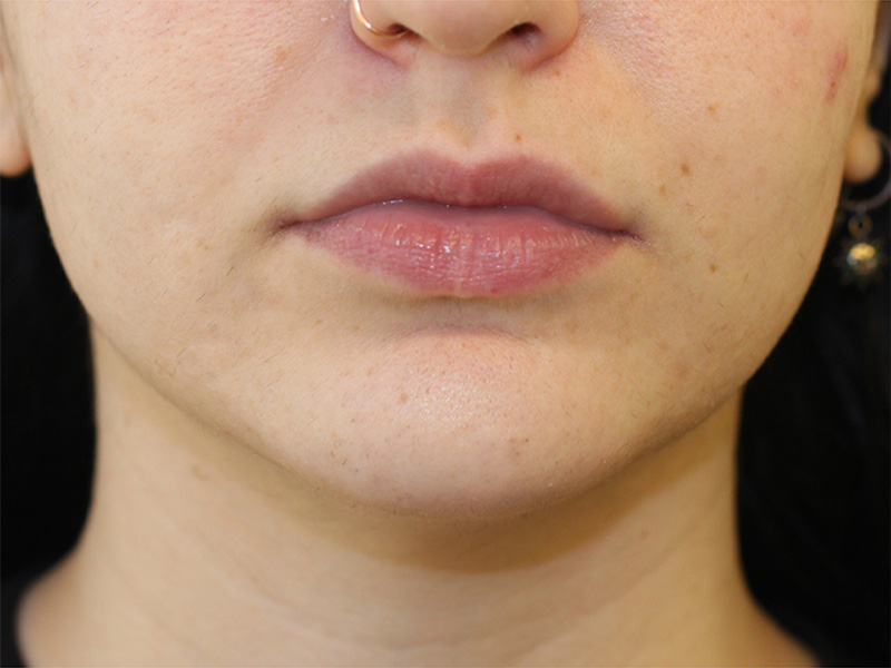 Filler Before and After | PERK Plastic Surgery