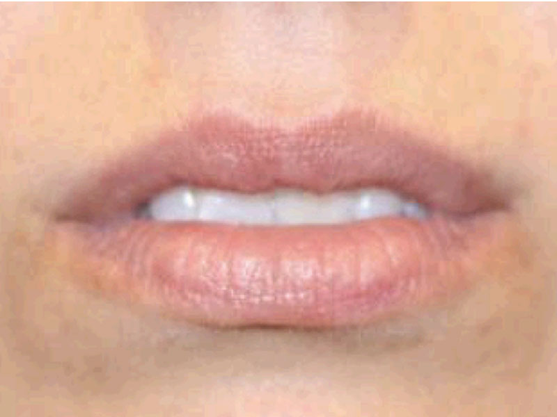 Filler Before and After | PERK Plastic Surgery