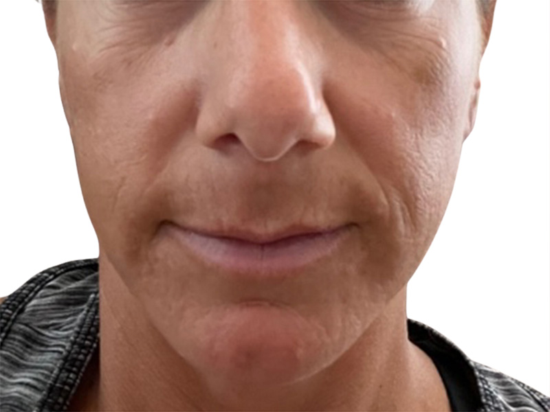 Filler Before and After | PERK Plastic Surgery