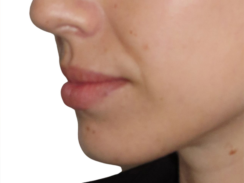 Filler Before and After | PERK Plastic Surgery