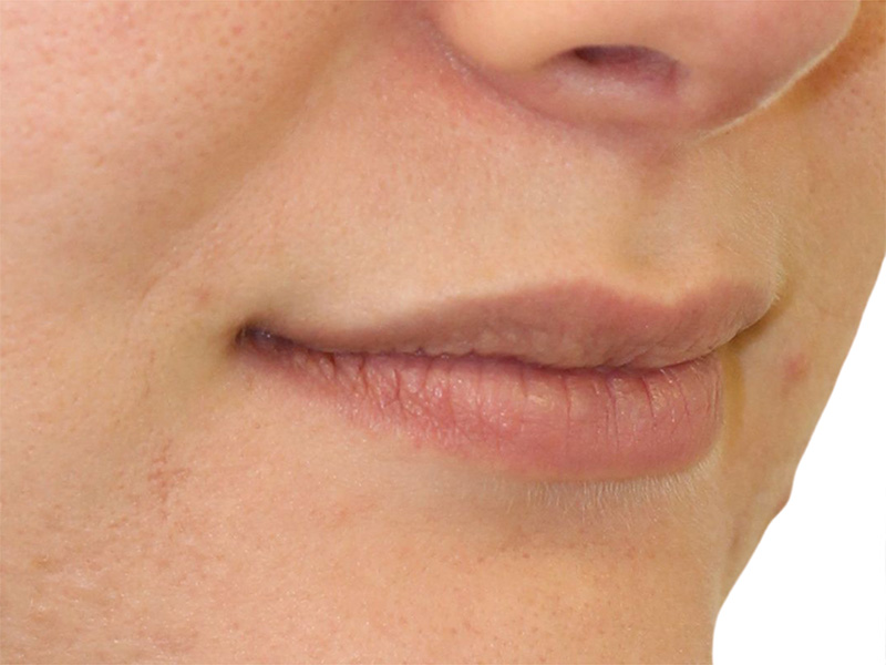 Filler Before and After | PERK Plastic Surgery