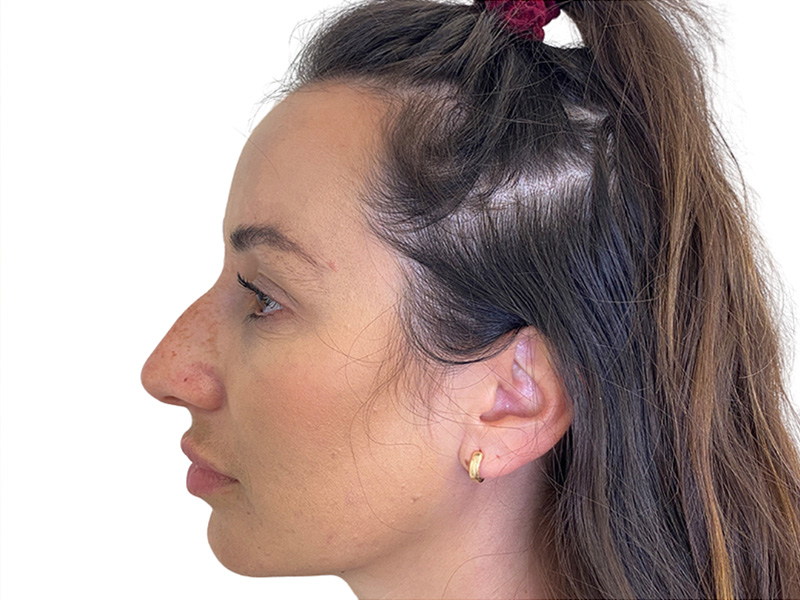 Filler Before and After | PERK Plastic Surgery
