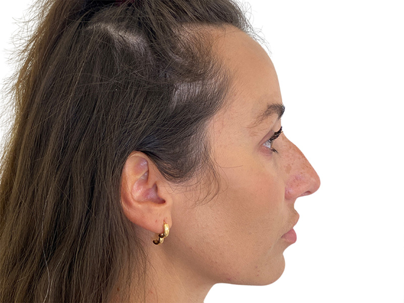 Filler Before and After | PERK Plastic Surgery