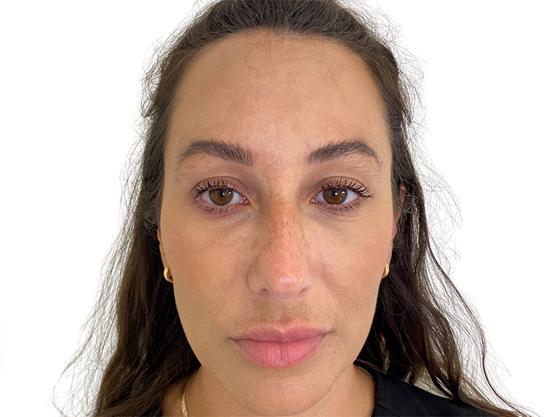 Filler Before and After | PERK Plastic Surgery