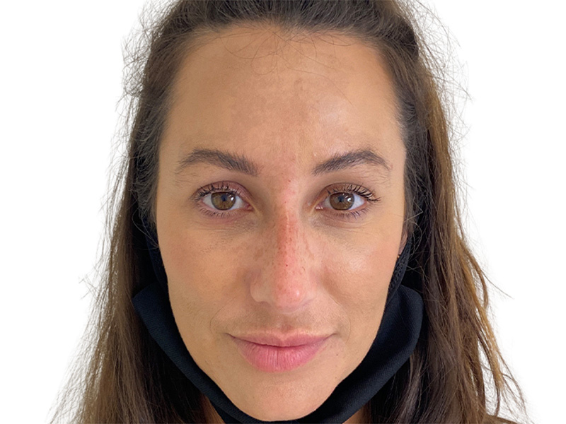 Filler Before and After | PERK Plastic Surgery