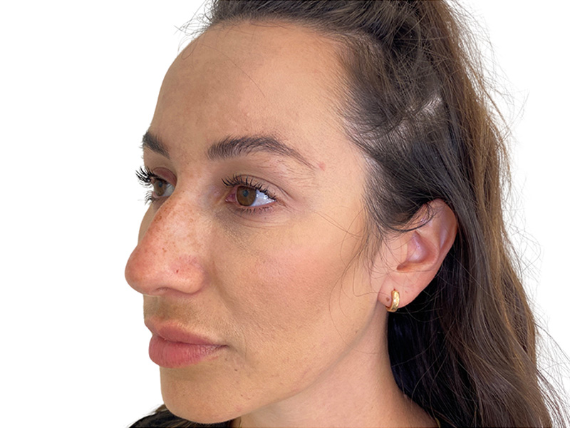 Filler Before and After | PERK Plastic Surgery
