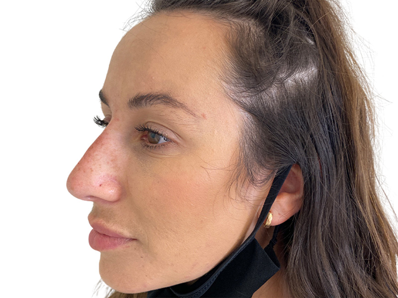 Filler Before and After | PERK Plastic Surgery