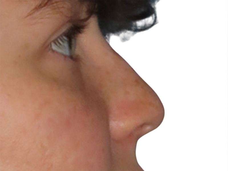 Filler Before and After | PERK Plastic Surgery