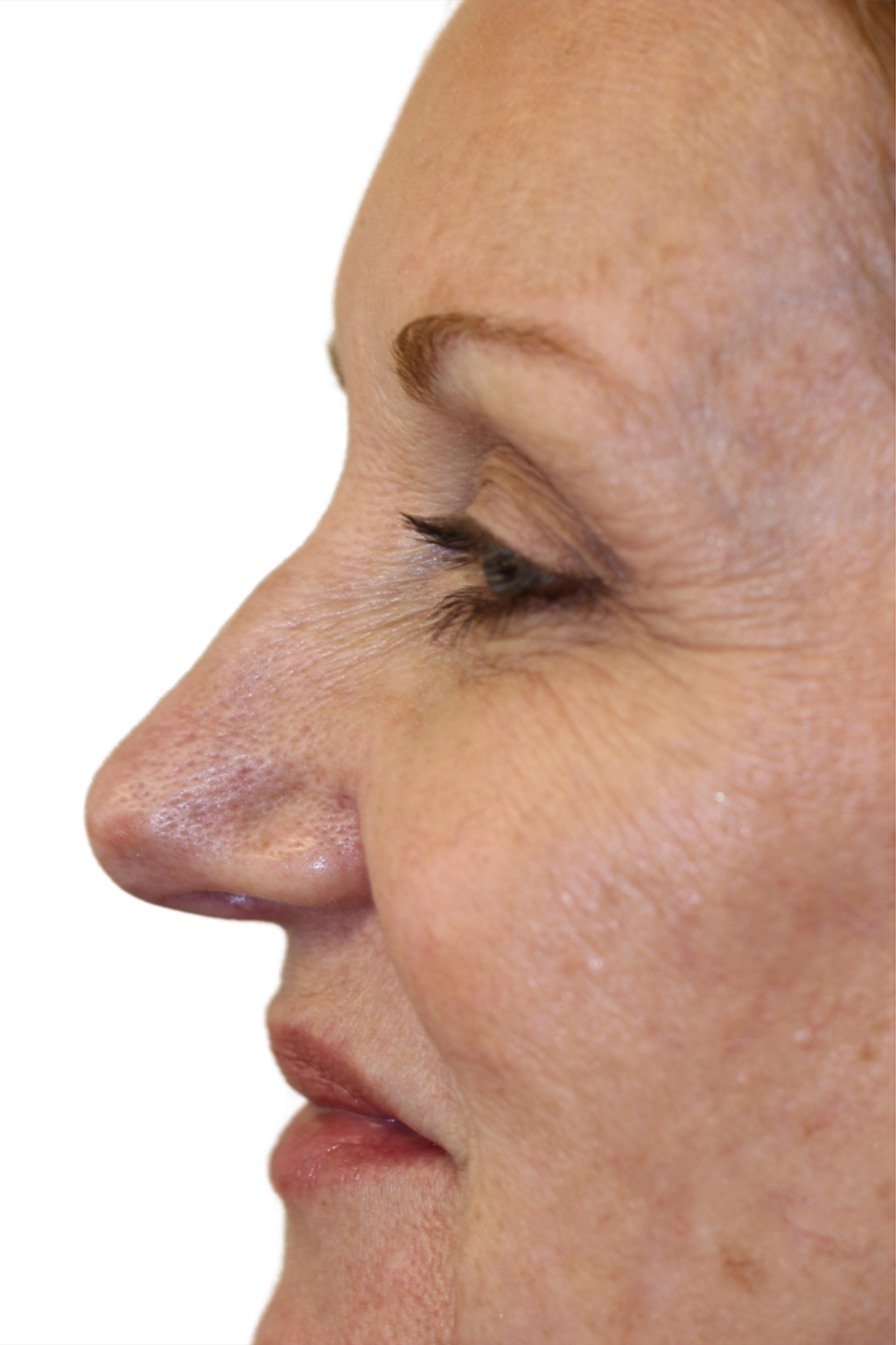 Filler Before and After | PERK Plastic Surgery