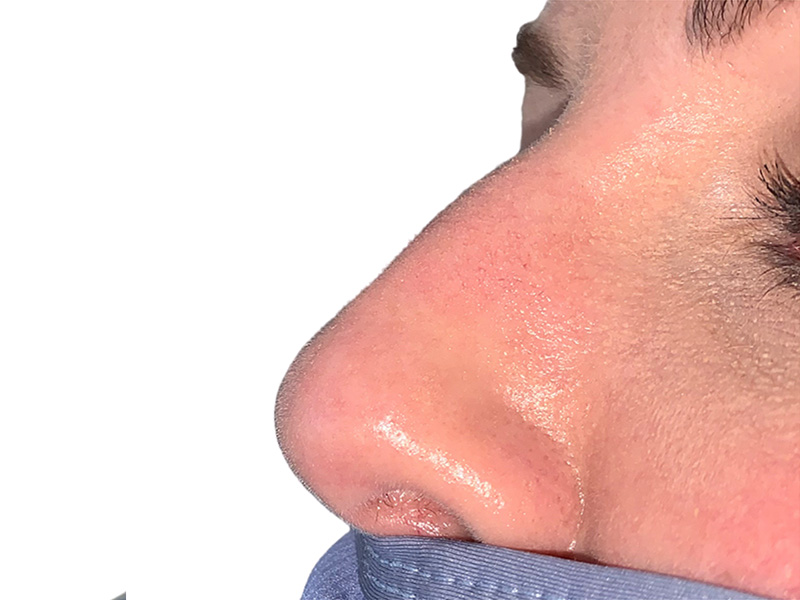 Filler Before and After | PERK Plastic Surgery