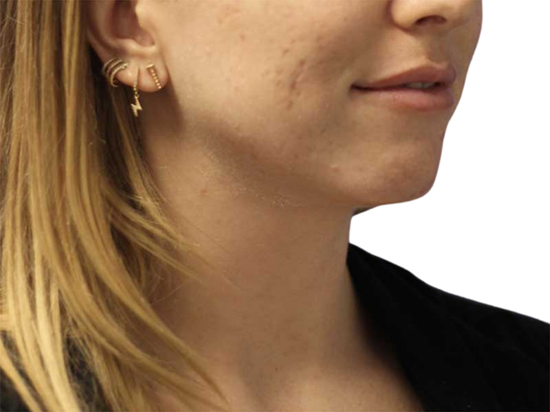 Filler Before and After | PERK Plastic Surgery