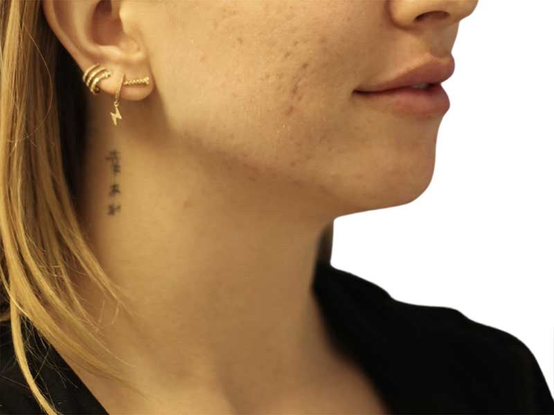 Filler Before and After | PERK Plastic Surgery