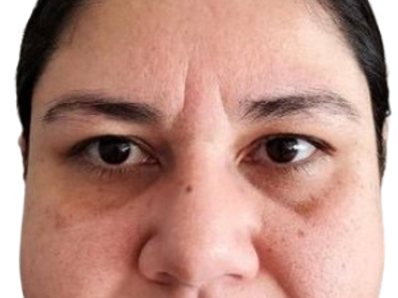 Filler Before and After | PERK Plastic Surgery