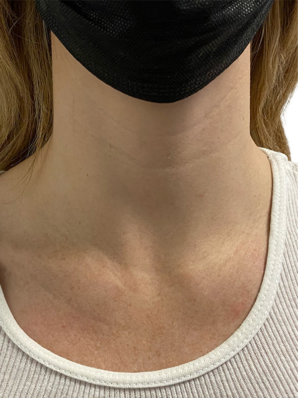 Filler Before and After | PERK Plastic Surgery
