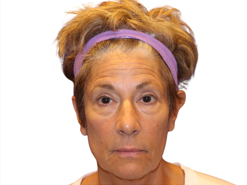 Filler Before and After | PERK Plastic Surgery