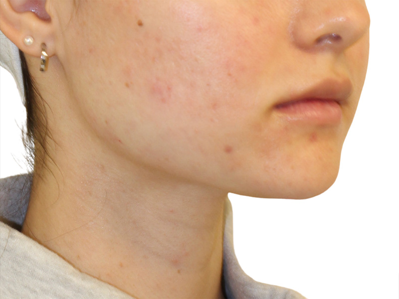 Filler Before and After | PERK Plastic Surgery