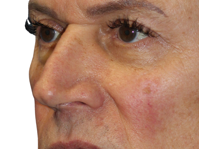 Filler Before and After | PERK Plastic Surgery