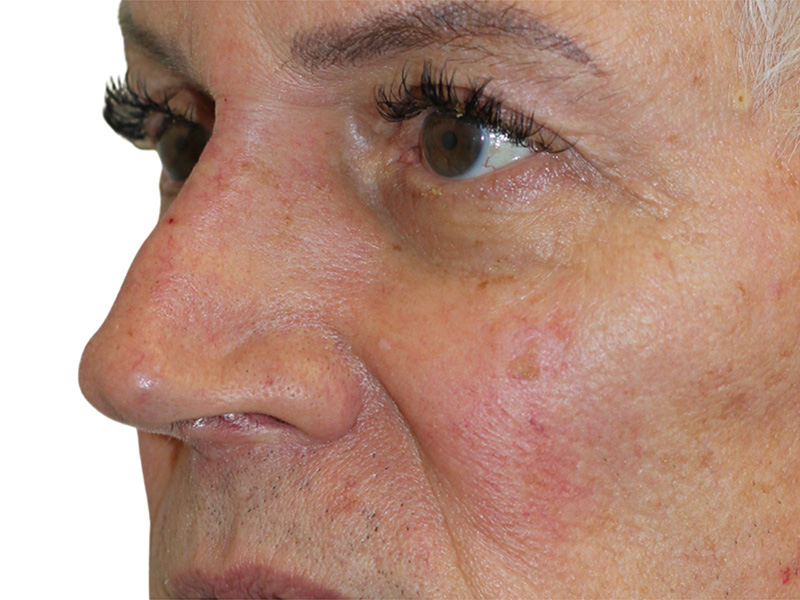 Filler Before and After | PERK Plastic Surgery