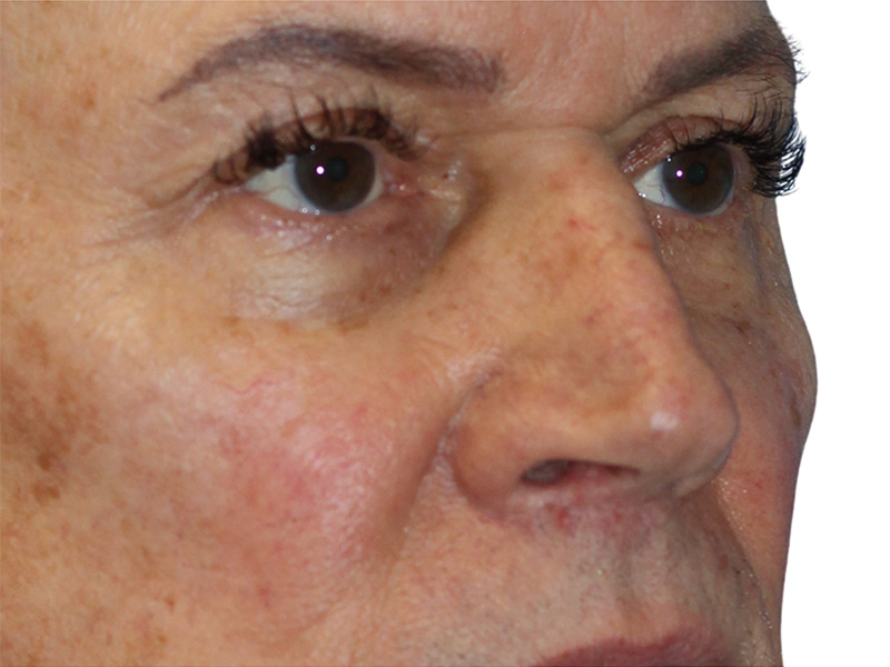 Filler Before and After | PERK Plastic Surgery
