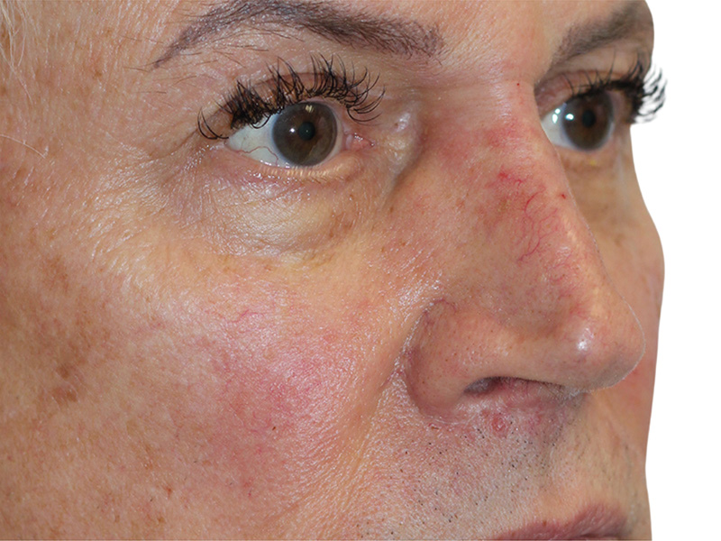 Filler Before and After | PERK Plastic Surgery
